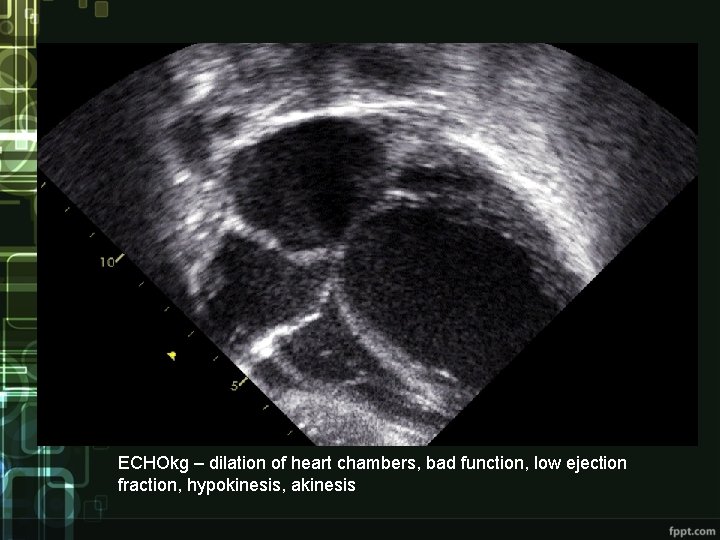 ECHOkg – dilation of heart chambers, bad function, low ejection fraction, hypokinesis, akinesis 