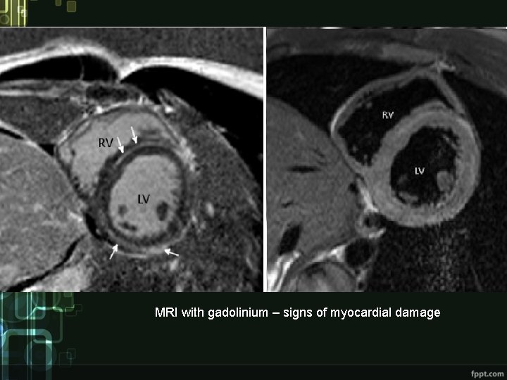 MRI with gadolinium – signs of myocardial damage 