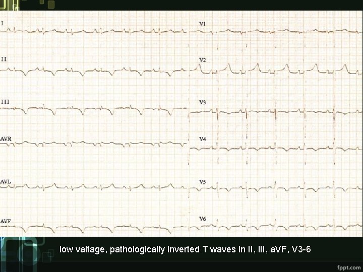 low valtage, pathologically inverted T waves in II, III, a. VF, V 3 -6