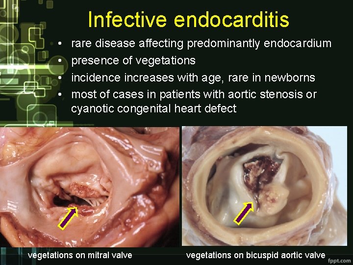 Infective endocarditis • • rare disease affecting predominantly endocardium presence of vegetations incidence increases