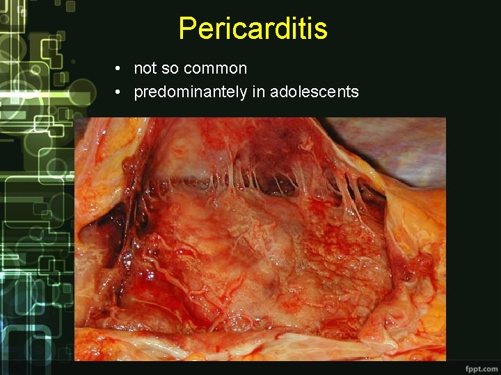 Pericarditis • not so common • predominantely in adolescents 