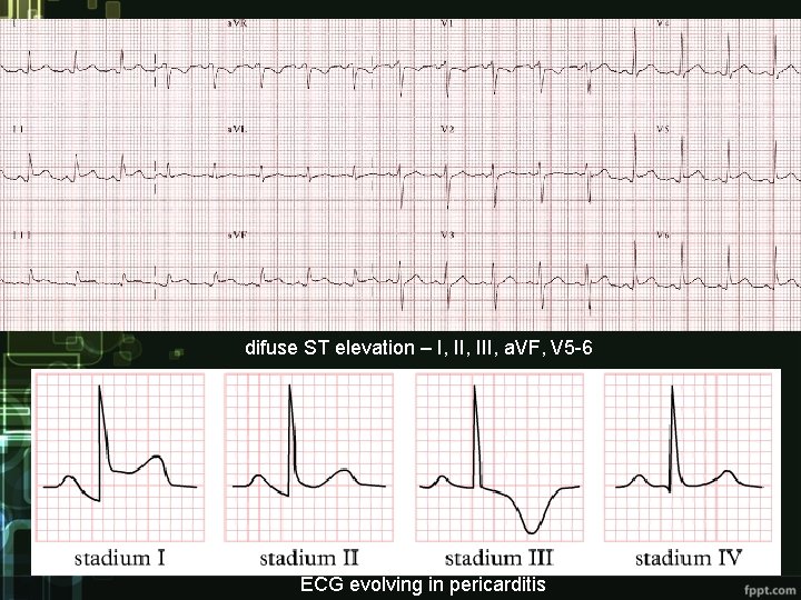 difuse ST elevation – I, III, a. VF, V 5 -6 ECG evolving in
