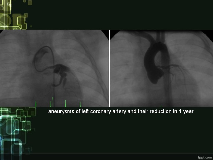 aneurysms of left coronary artery and their reduction in 1 year 