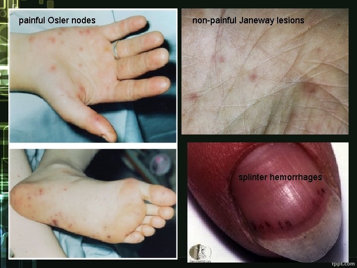 painful Osler nodes non-painful Janeway lesions splinter hemorrhages 