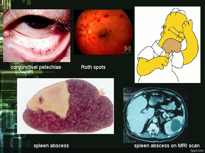 conjunctival petechiae spleen abscess Roth spots spleen abscess on MRI scan 