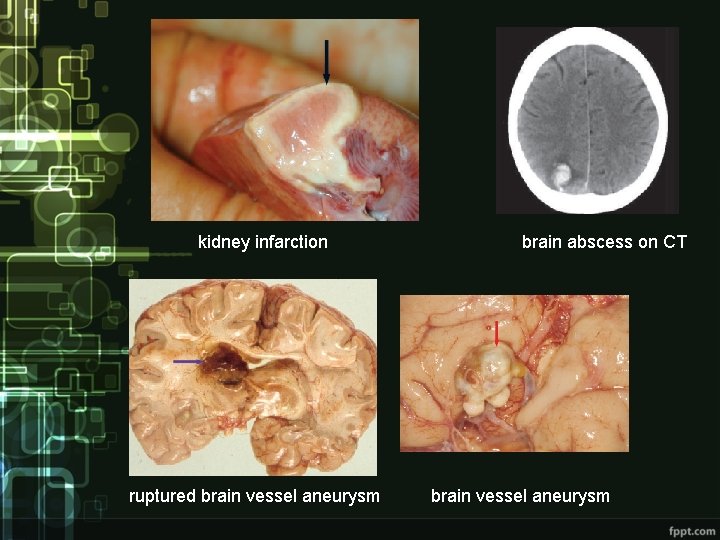 kidney infarction ruptured brain vessel aneurysm brain abscess on CT brain vessel aneurysm 