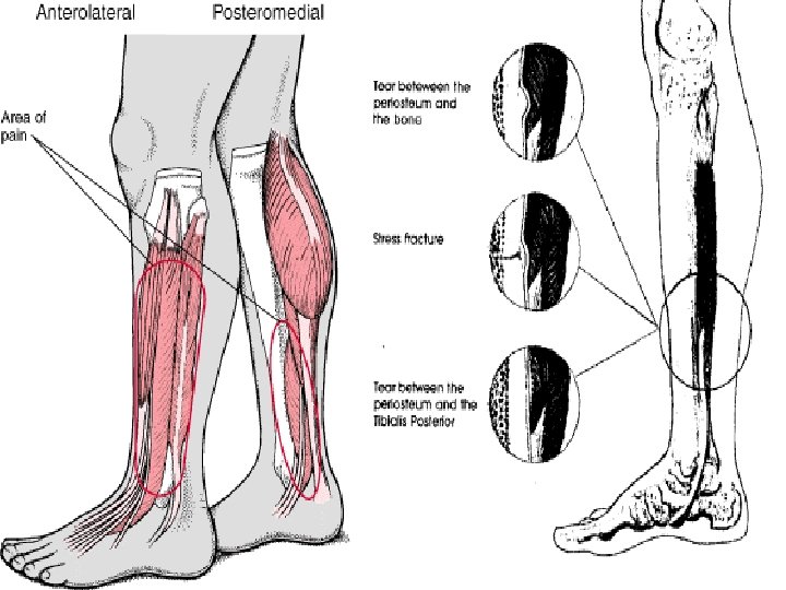 Injuries to the Lower Leg Foot and Ankle