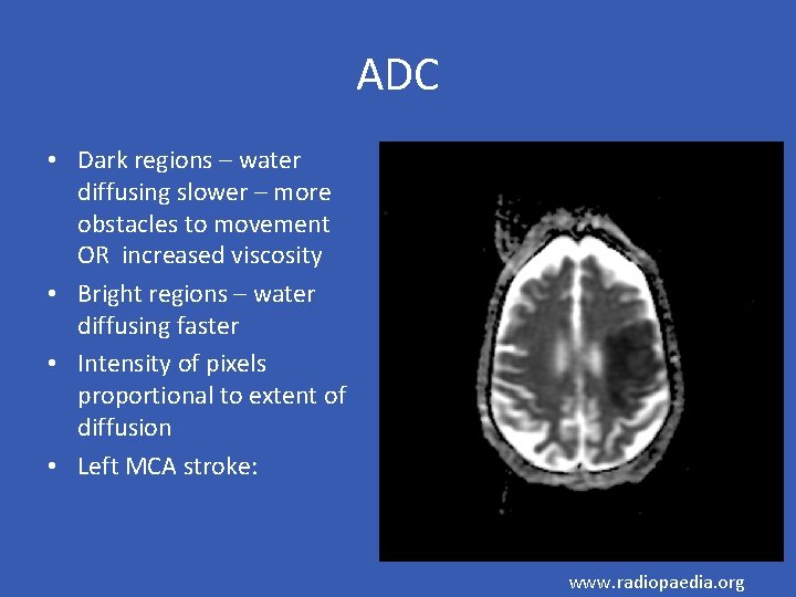 ADC • Dark regions – water diffusing slower – more obstacles to movement OR