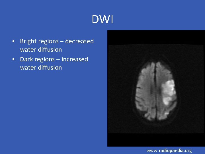 DWI • Bright regions – decreased water diffusion • Dark regions – increased water