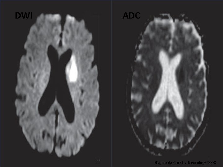 DWI ADC Hygino da Cruz Jr, Neurology 2008 