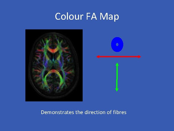 Colour FA Map Demonstrates the direction of fibres 