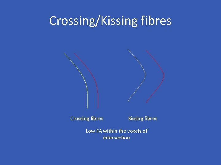 Crossing/Kissing fibres Crossing fibres Kissing fibres Low FA within the voxels of intersection 