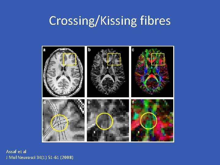 Crossing/Kissing fibres Assaf et al J Mol Neurosci 34(1) 51 -61 (2008) 