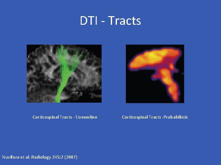 DTI - Tracts Corticospinal Tracts - Streamline Nucifora et al. Radiology 245: 2 (2007)