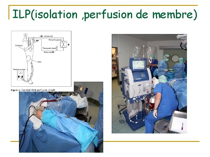 ILP(isolation , perfusion de membre) 