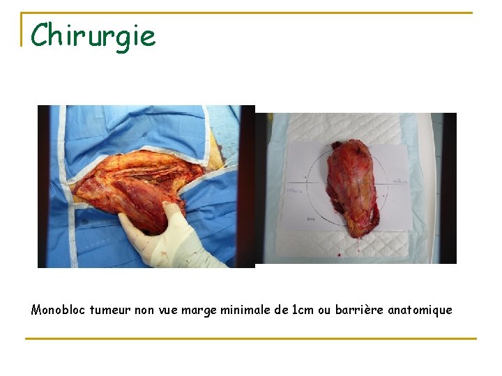 Chirurgie Monobloc tumeur non vue marge minimale de 1 cm ou barrière anatomique 