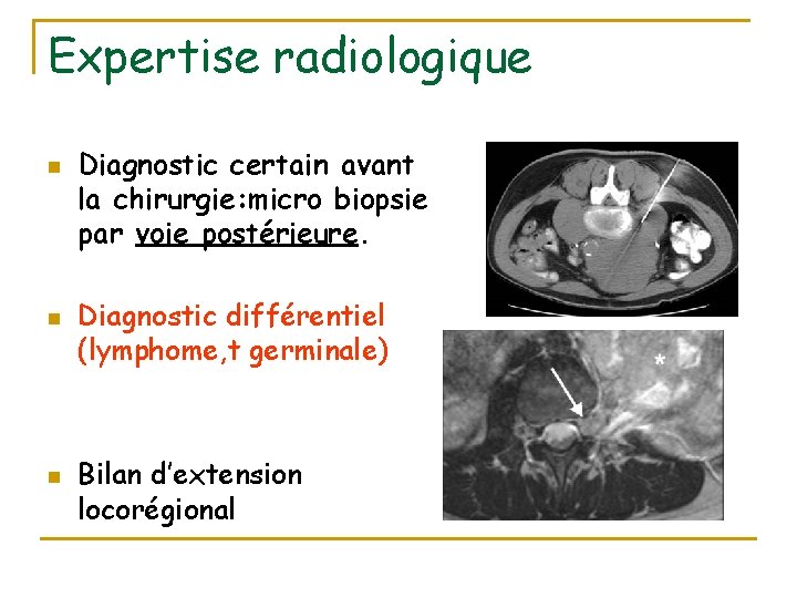 Expertise radiologique n n n Diagnostic certain avant la chirurgie: micro biopsie par voie