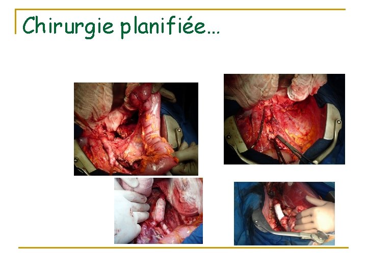 Chirurgie planifiée… 