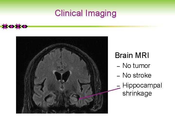 Clinical Imaging Brain MRI ‒ ‒ ‒ No tumor No stroke Hippocampal shrinkage 