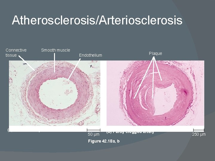 Atherosclerosis/Arteriosclerosis Connective tissue (a) Normal artery Smooth muscle Plaque Endothelium 50 µm (b) Partly