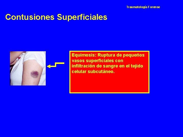 Traumatología Forense Contusiones Superficiales Equimosis: Ruptura de pequeños vasos superficiales con infiltración de sangre