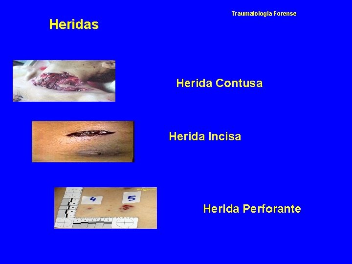 Heridas Traumatología Forense Herida Contusa Herida Incisa Herida Perforante 