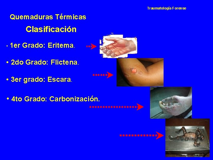 Traumatología Forense Quemaduras Térmicas Clasificación • 1 er Grado: Eritema. • 2 do Grado: