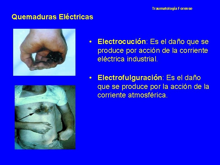 Traumatología Forense Quemaduras Eléctricas • Electrocución: Es el daño que se produce por acción