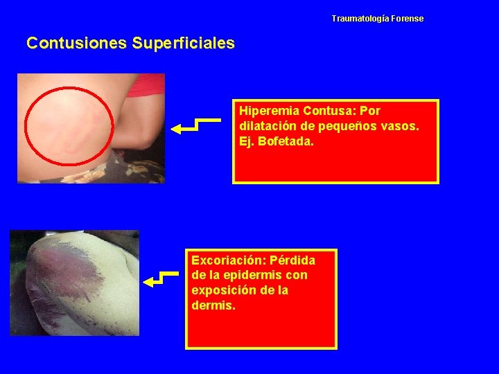 Traumatología Forense Contusiones Superficiales Hiperemia Contusa: Por dilatación de pequeños vasos. Ej. Bofetada. Excoriación: