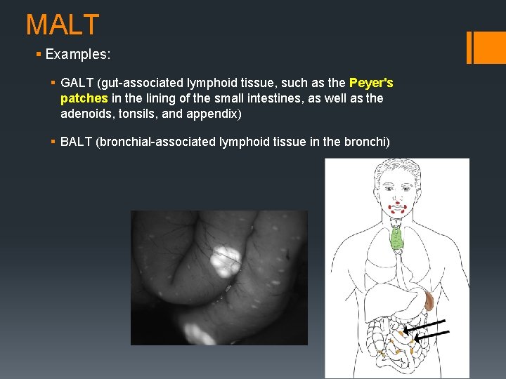 MALT § Examples: § GALT (gut-associated lymphoid tissue, such as the Peyer's patches in