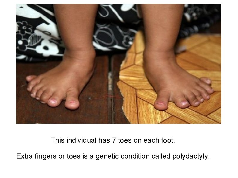 This individual has 7 toes on each foot. Extra fingers or toes is a