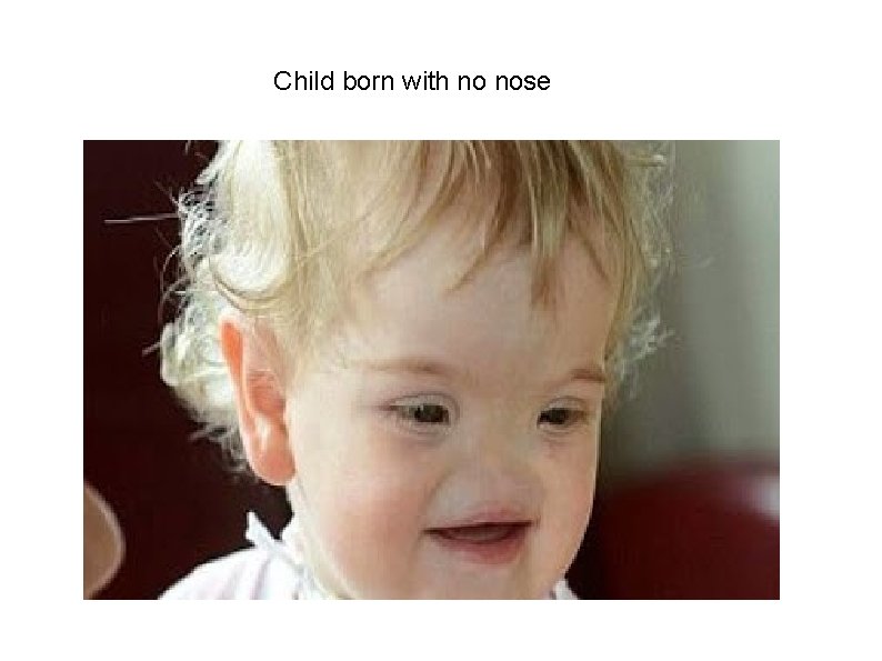 Child born with no nose 