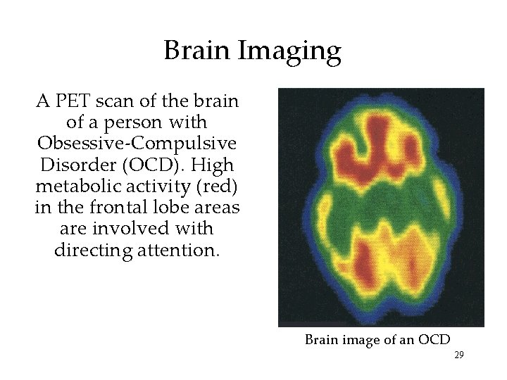 Brain Imaging A PET scan of the brain of a person with Obsessive-Compulsive Disorder