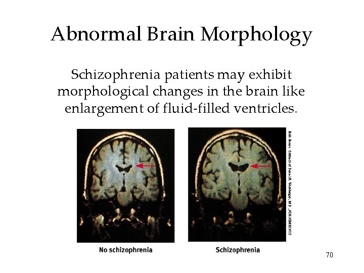 Abnormal Brain Morphology Schizophrenia patients may exhibit morphological changes in the brain like enlargement