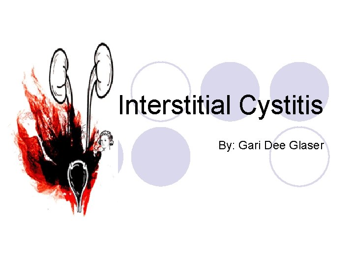 Interstitial Cystitis By: Gari Dee Glaser 