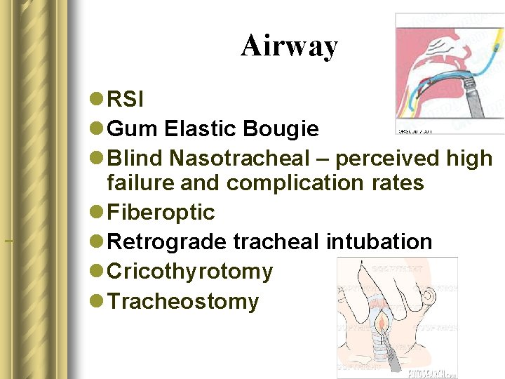 Airway l RSI l Gum Elastic Bougie l Blind Nasotracheal – perceived high failure