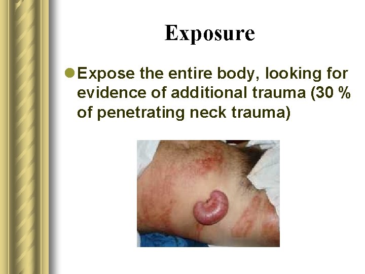 Exposure l Expose the entire body, looking for evidence of additional trauma (30 %