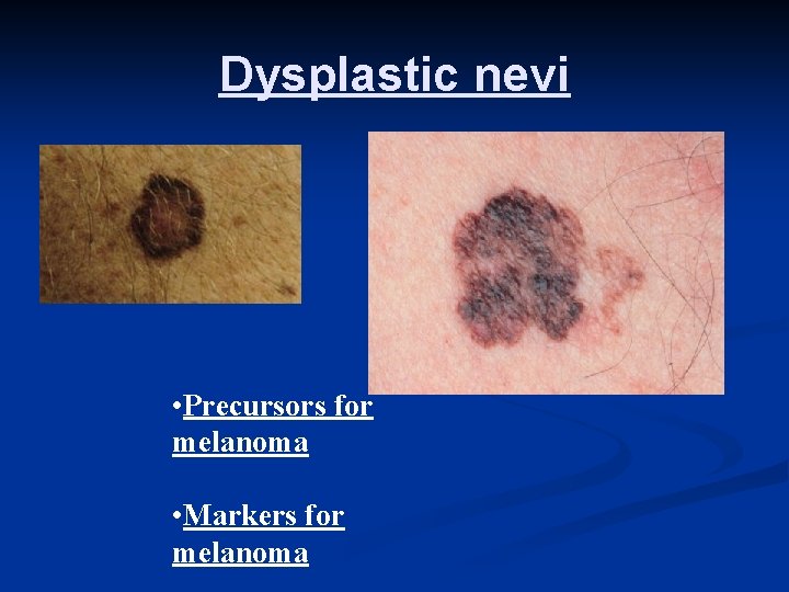 Dysplastic nevi • Precursors for melanoma • Markers for melanoma 