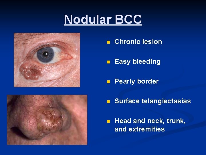 Nodular BCC n Chronic lesion n Easy bleeding n Pearly border n Surface telangiectasias