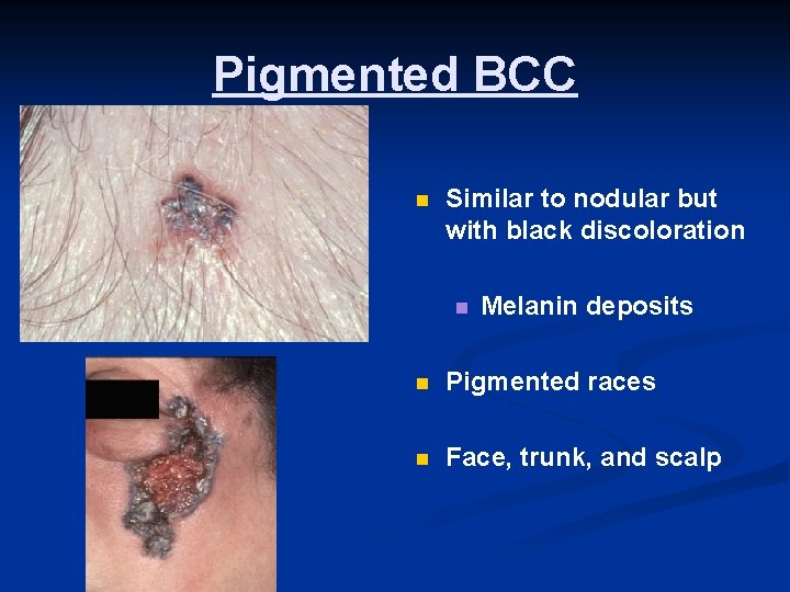 Pigmented BCC n Similar to nodular but with black discoloration n Melanin deposits n