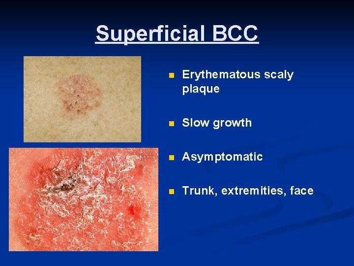 Superficial BCC n Erythematous scaly plaque n Slow growth n Asymptomatic n Trunk, extremities,