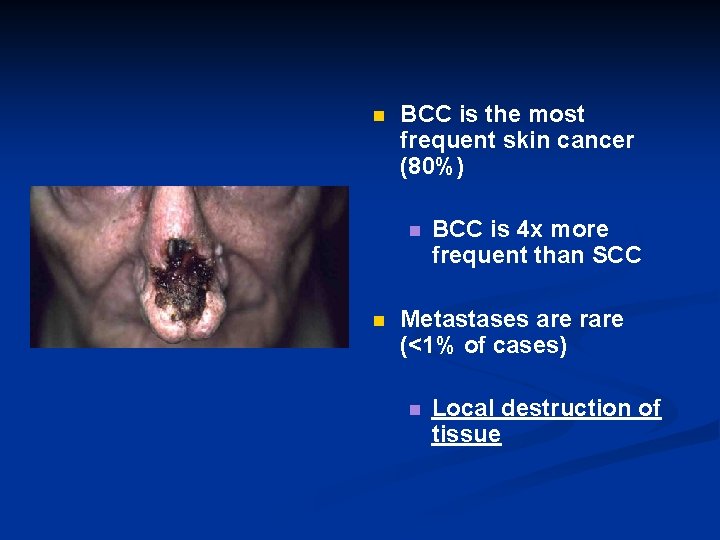 n BCC is the most frequent skin cancer (80%) n n BCC is 4