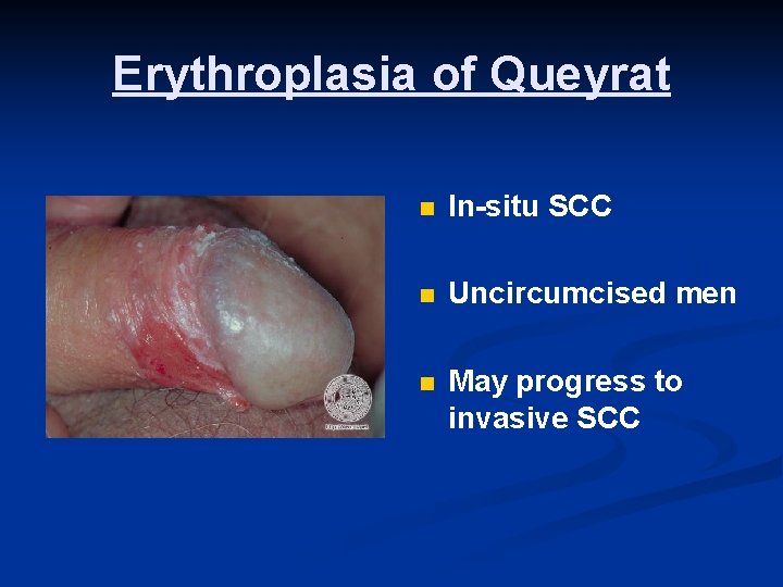 Erythroplasia of Queyrat n In-situ SCC n Uncircumcised men n May progress to invasive