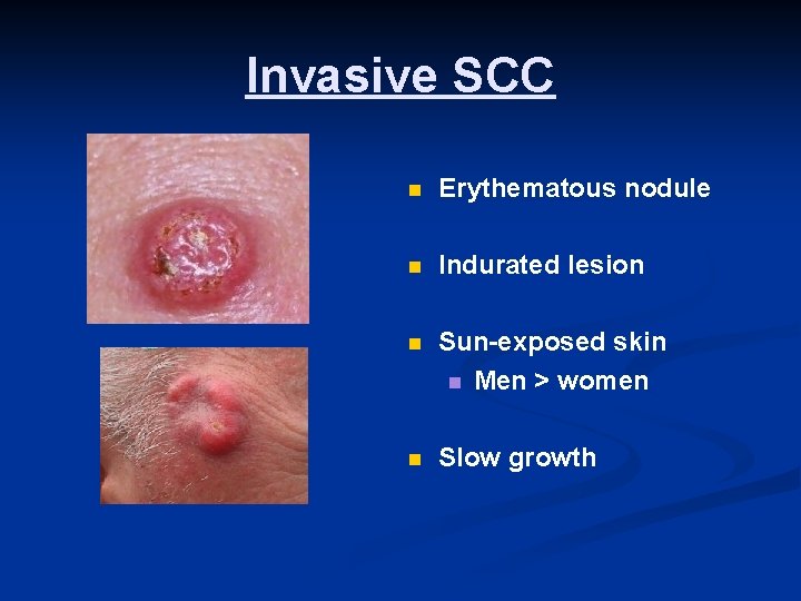 Invasive SCC n Erythematous nodule n Indurated lesion n Sun-exposed skin n Men >