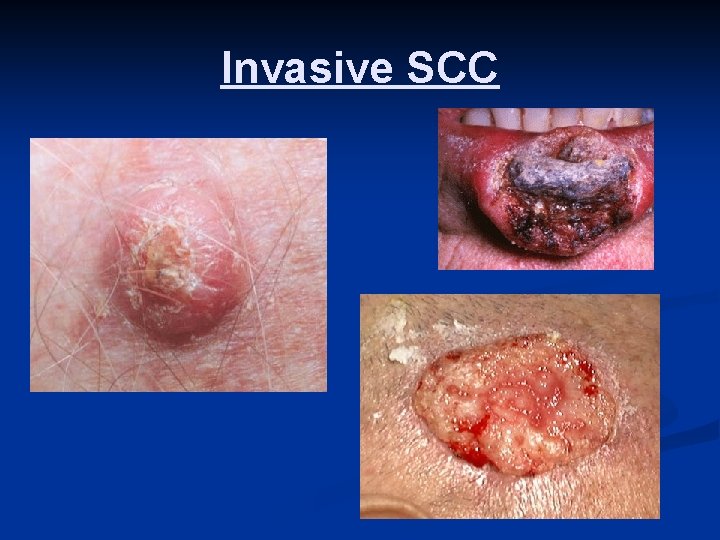 Invasive SCC 