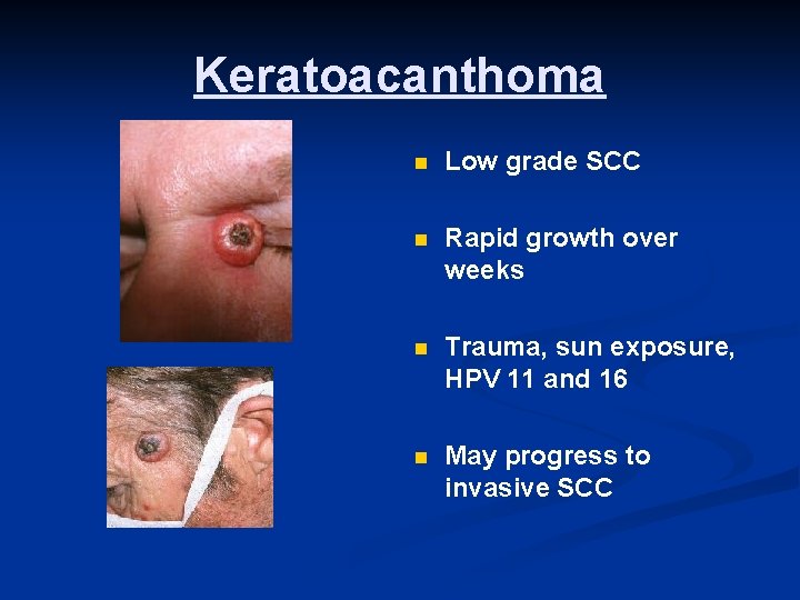 Keratoacanthoma n Low grade SCC n Rapid growth over weeks n Trauma, sun exposure,