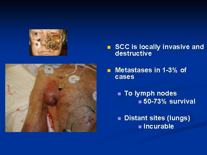 n SCC is locally invasive and destructive n Metastases in 1 -3% of cases