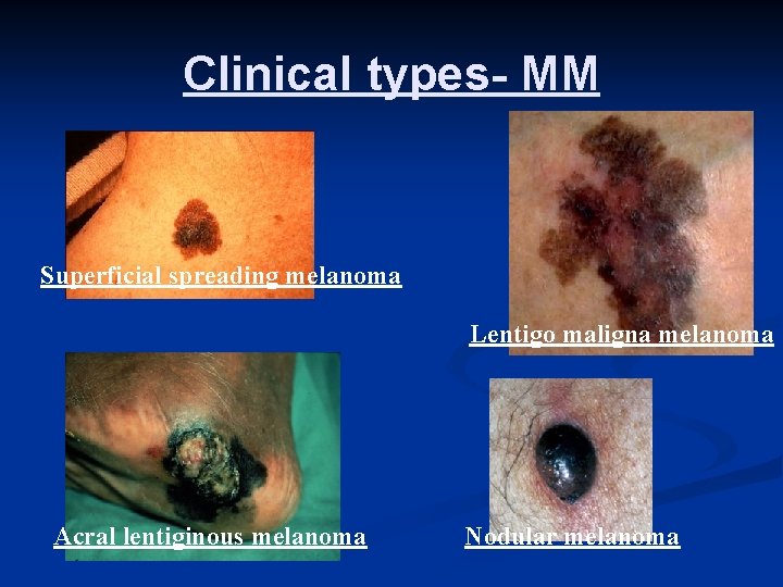Clinical types- MM Superficial spreading melanoma Lentigo maligna melanoma Acral lentiginous melanoma Nodular melanoma