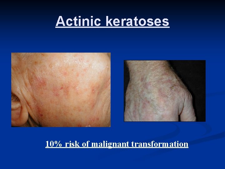 Actinic keratoses 10% risk of malignant transformation 