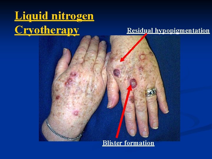 Liquid nitrogen Cryotherapy Residual hypopigmentation Blister formation 